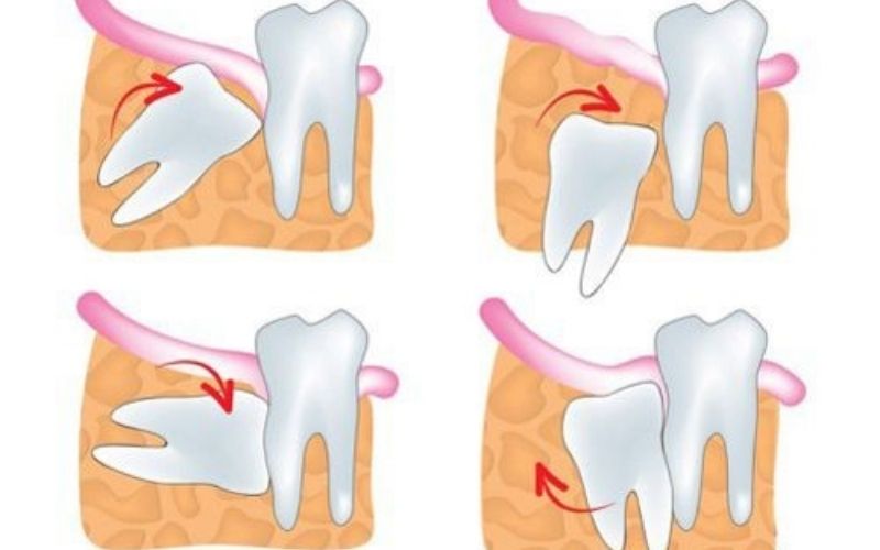 Răng khôn mọc lệch là mối nguy hại cho răng