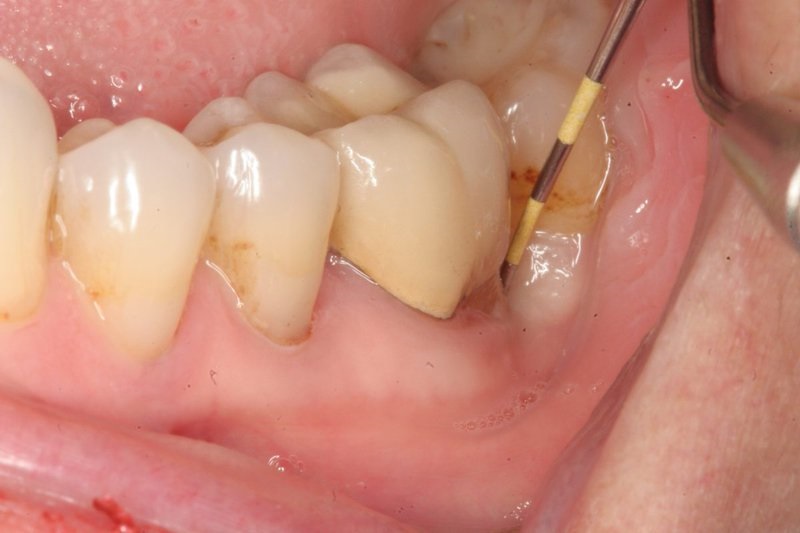 Áp-xe quanh cuống răng có thể khiến bạn có cảm giác đau tại răng