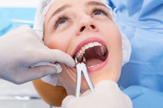 Quy trình nhổ răng cối cần được thực hiện bởi bác sĩ có chuyên môn
