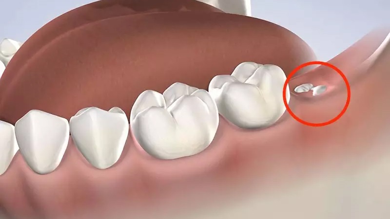 Răng khôn là chiếc răng cuối cùng được mọc trên cung hàm