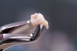 Nhổ răng khôn cần được thực hiện ở nha khoa uy tín