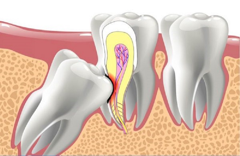 Nhổ răng số 8 bị sâu theo chỉ định của bác sĩ sẽ được hưởng bảo hiểm