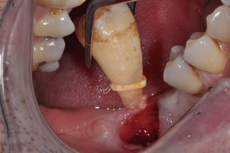 Nhổ răng khôn bằng công nghệ mới sẽ hạn chế tình trạng chảy máu và đau nhức