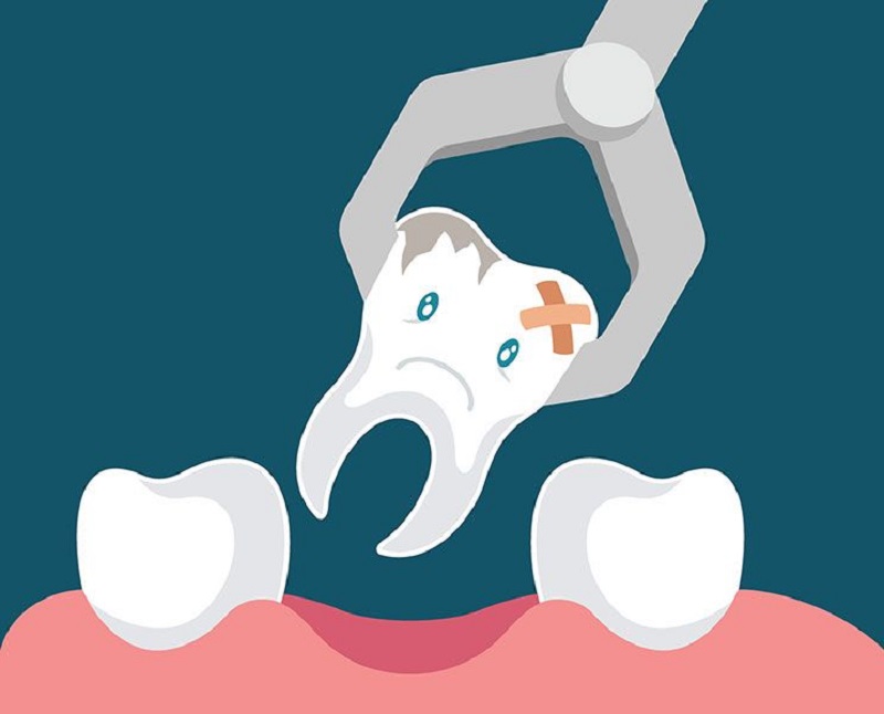 Trước khi nhổ răng bạn sẽ được tiêm thuốc tê để giảm đau