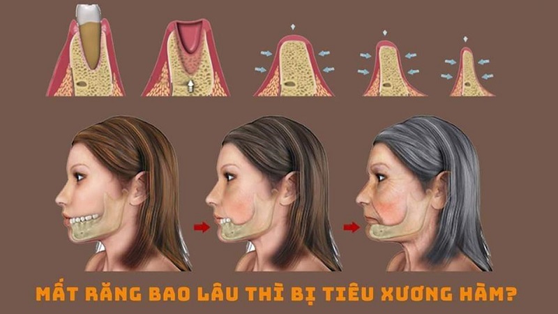 Mất răng lâu sẽ bị tiêu xương hàm