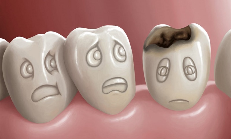 Răng sâu không được điều trị triệt để trước khi tẩy trắng là nguyên nhân dẫn đến các cơn ê buốt răng