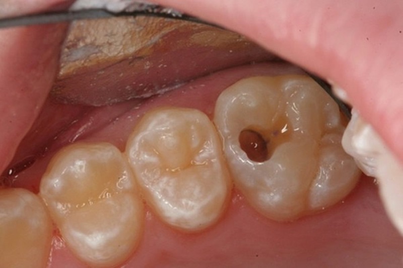 Răng số 6 bị sâu nghiêm trọng nếu không nhổ đi có thể sẽ làm lây lan sang các răng lân cận