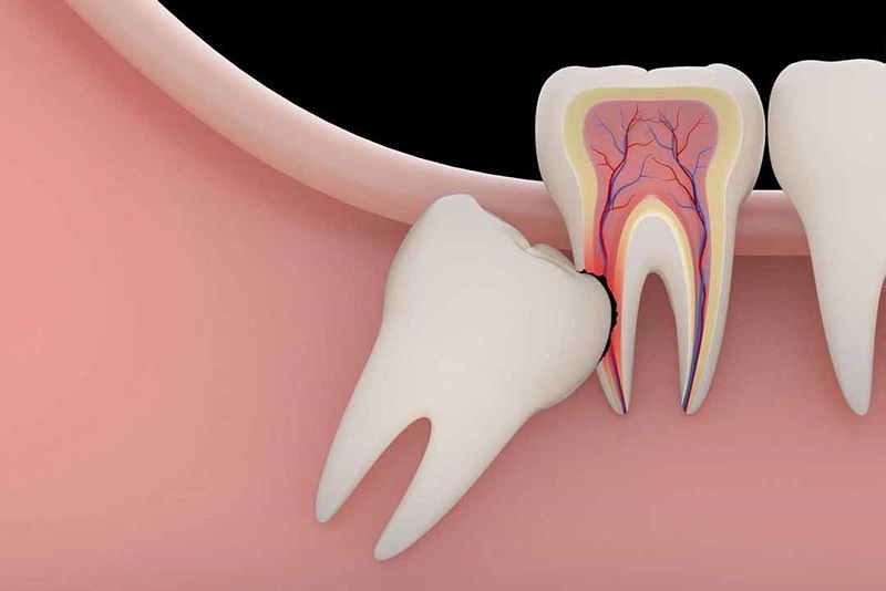 Dùng thuốc tê hay mê còn phụ thuộc vào tình trạng răng miệng của bệnh nhân