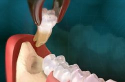 Nhổ răng gây tê hay mê sẽ do bác sĩ quyết định