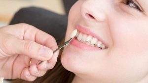 Nhổ răng khểnh cần được thực hiện khi răng khểnh bị sâu, viêm nha chu hoặc ảnh hưởng đến thẩm mỹ
