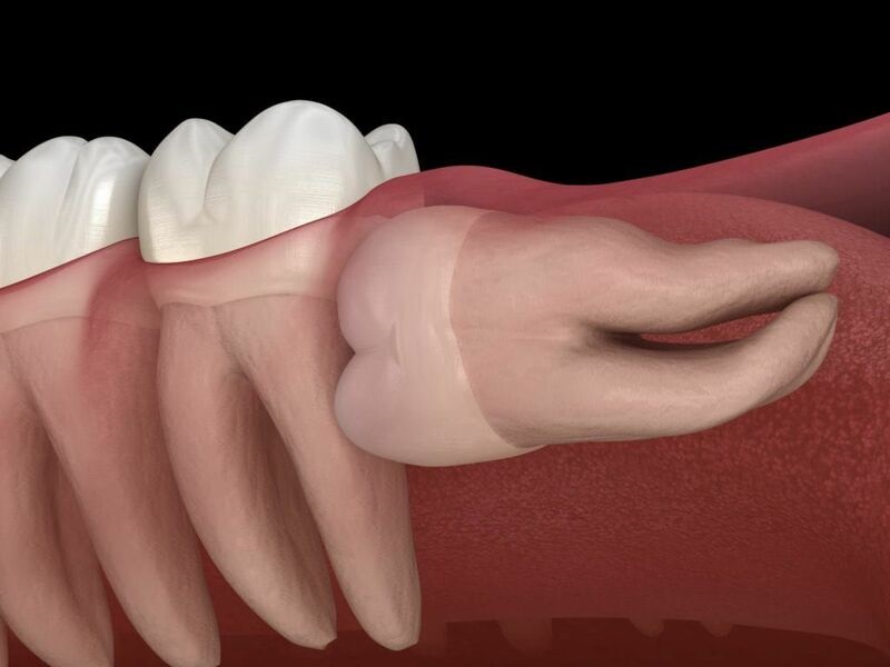 Trường hợp răng khôn mọc ngang đâm vào răng số 7