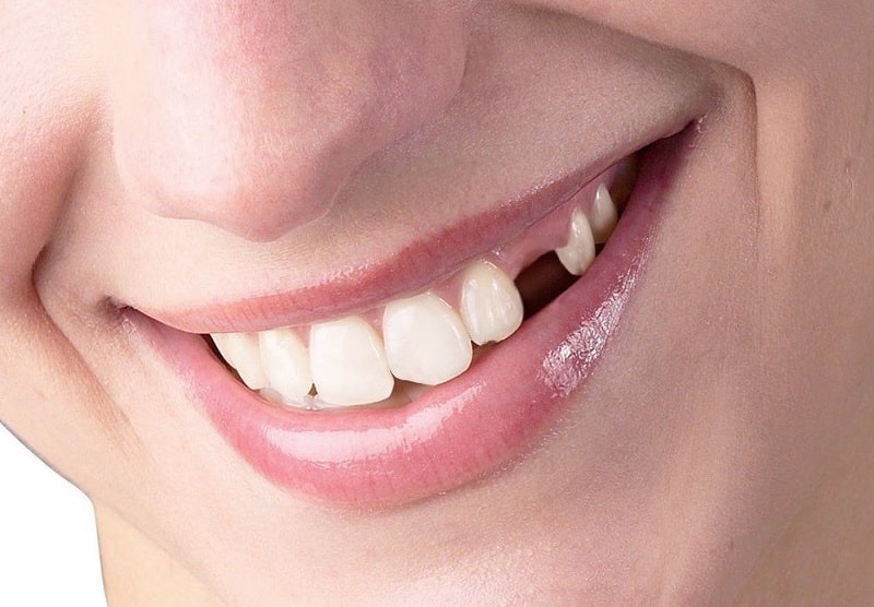 Cần nhổ bỏ răng khi răng bị nhô ra, bị sâu hoặc viêm tủy