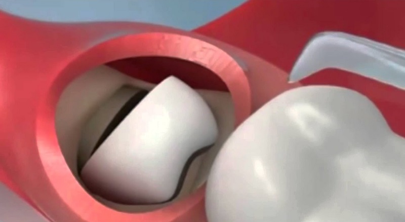 Khi nhổ răng các bác sĩ sẽ thực hiện theo quy trình an toàn