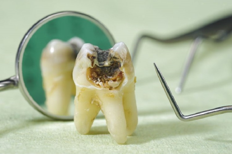 Sâu răng là một bệnh lý nha khoa xảy ra do vi khuẩn tấn công, phá hủy mô cứng của răng