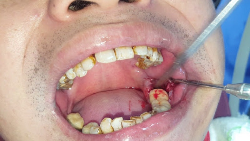 Nhổ răng sâu là phương pháp điều trị sâu răng hiệu quả nhất