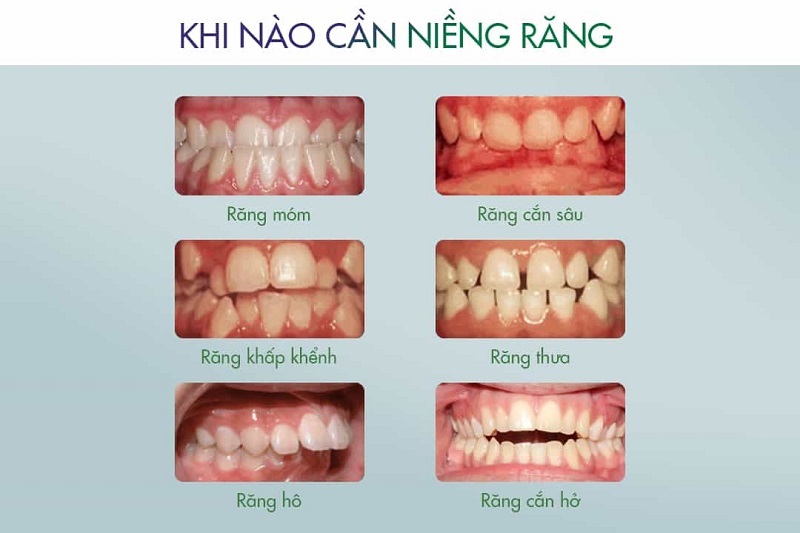 Các trường hợp nên niềng răng