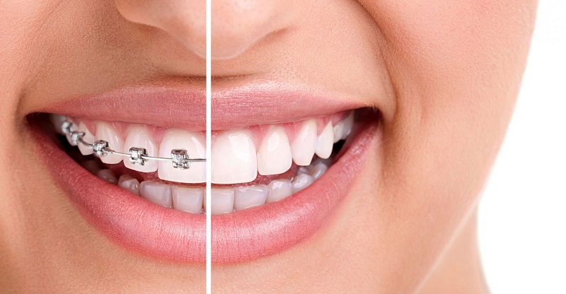 Chỉnh nha giúp bạn có một nụ cười hoàn hảo với hàm răng đều đẹp