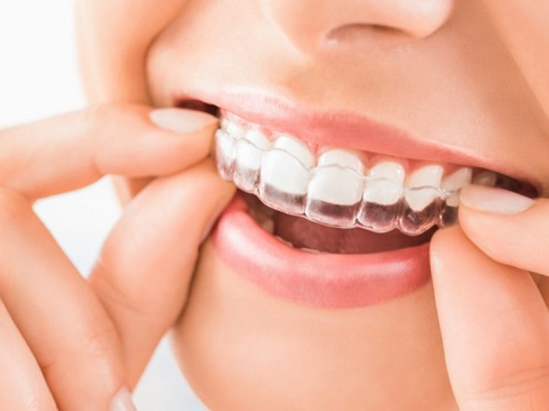 Niềng răng trong suốt Clear aligner là phương pháp ngày càng được ưa chuộng