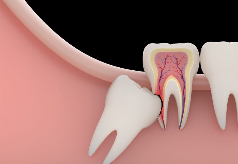 Răng số 8 hàm dưới còn có thể làm cho các răng khác bị xô lệch