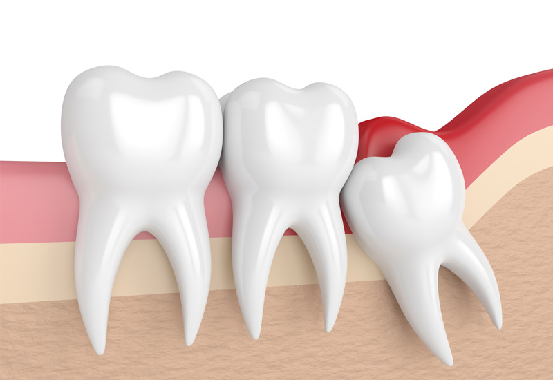 Khả năng răng khôn hàm dưới mọc lệch và khiến cho nướu bị sưng viêm là rất cao