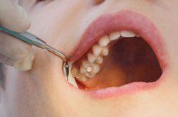 Nhổ răng khôn hàm trên thường được bác sĩ chỉ định trong nhiều trường hợp