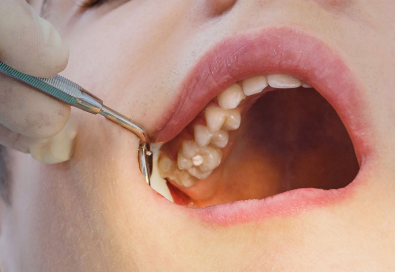 Trong nhiều trường hợp, nhổ răng khôn hàm trên là chỉ định bắt buộc