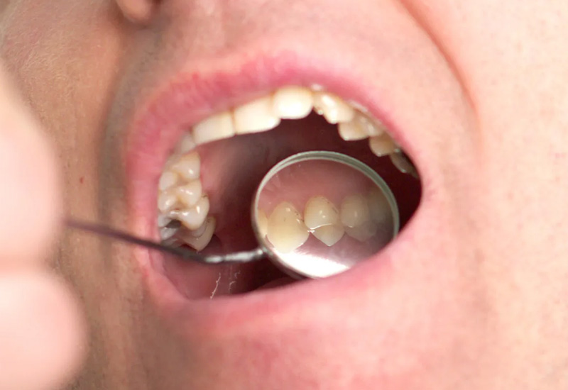 Răng khôn là những chiếc răng mọc lên sau cùng và cũng tiềm ẩn nhiều vấn đề nguy hiểm