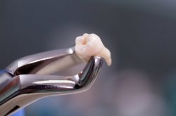 Nhổ răng khôn mọc lệch được chỉ định trong hầu hết các trường hợp gặp phải vấn đề này