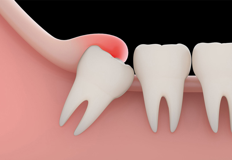 răng khôn mọc lệch có thể dẫn đến nhiều biến chứng nguy hiểm