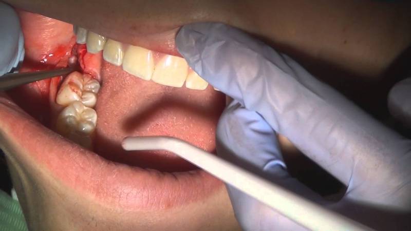 Phương pháp nhổ răng khôn bằng kìm nha khoa