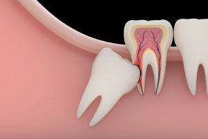 Quy Trình Nhổ Răng Khôn Mọc Ngầm Như Nào? Cần Lưu Ý Những Gì?