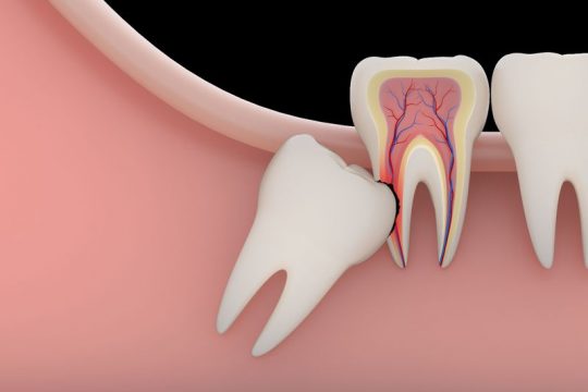 Quy Trình Nhổ Răng Khôn Mọc Ngầm Như Nào? Cần Lưu Ý Những Gì?
