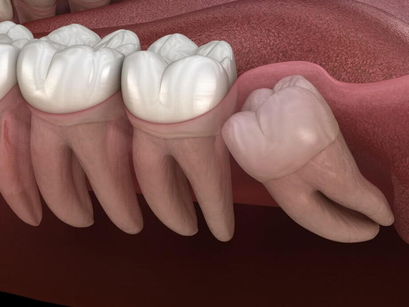 Răng khôn mọc ngầm là tình trạng răng khôn bị kẹt lại dưới nướu, không thể trồi lên được