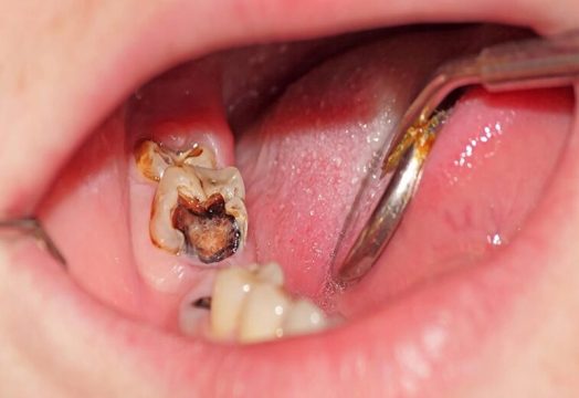 Nhổ răng số 8 bị sâu là rất cần thiết