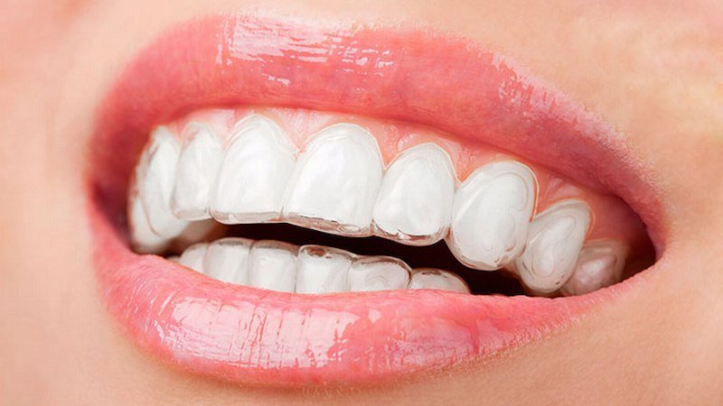 Răng sử dụng niềng Invisalign trong suốt