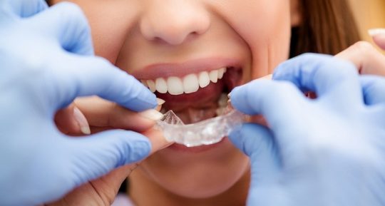 Niềng răng Invisalign là phương pháp niềng răng hiện đại nhất