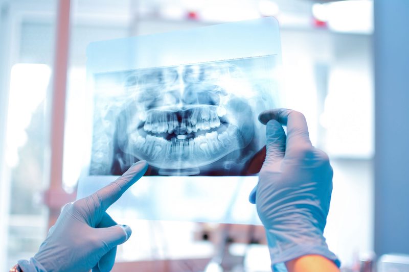 Cần chụp X-quang và lên phác đồ cụ thể trước khi quyết định có nhổ răng để niềng hay không