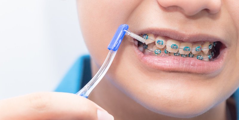 Trẻ em niềng răng không bắt buộc phải nhổ răng