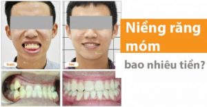 Giá niềng răng móm theo từng phương pháp