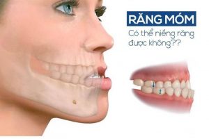 Niềng răng móm nên thực hiện càng sớm càng tốt