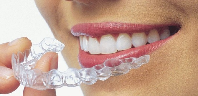 Niềng răng không mắc cài Invisalign được nhiều người có kinh tế lựa chọn