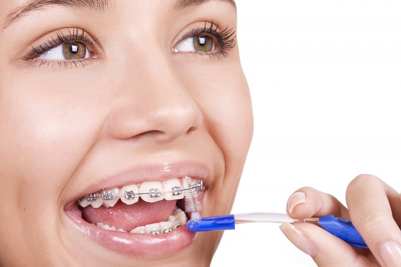 Vệ sinh răng sạch sẽ trong quá trình niềng răng bị móm
