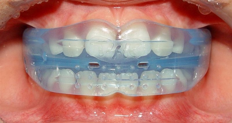 Niềng răng Trainer giúp khắc phục các vấn đề răng lệch lạc từ sớm