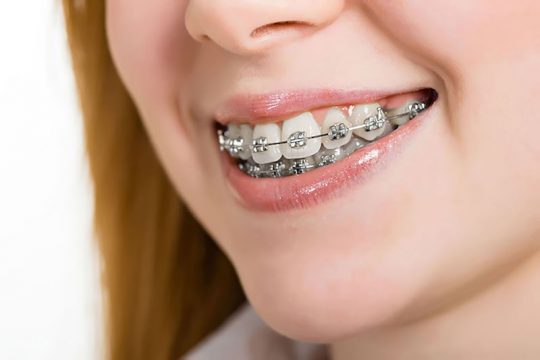 Quá Trình Niềng Răng Tiêu Chuẩn Diễn Ra Như Thế Nào?
