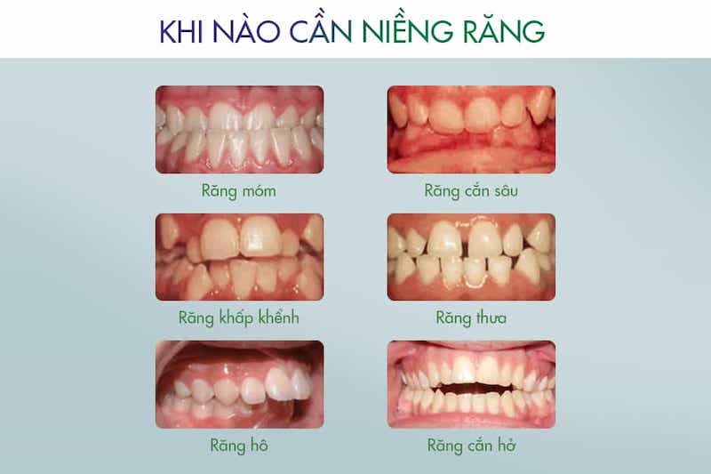 Các trường hợp nên chỉnh nha từ sớm