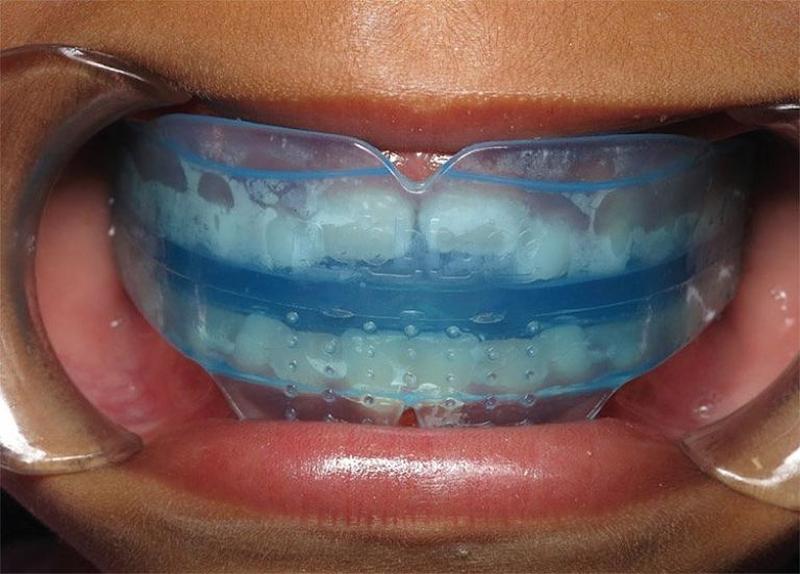Mỗi độ tuổi và tình trạng răng khác nhau sẽ phù hợp với loại niềng silicon khác nhau
