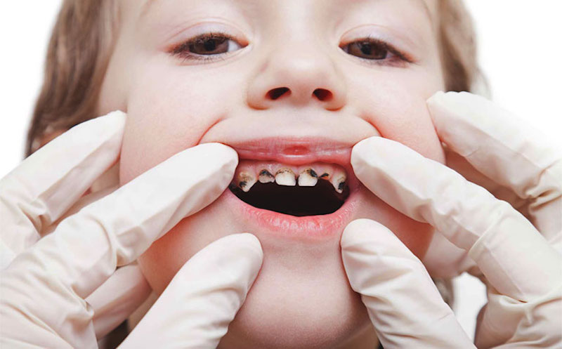 Sâu răng là vấn đề răng miệng thường gặp ở trẻ em