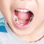 Sâu Răng Trẻ Em: Nguyên Nhân, Dấu Hiệu Và Cách Phòng Ngừa