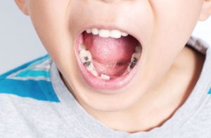 Sâu Răng Trẻ Em: Nguyên Nhân, Dấu Hiệu Và Cách Phòng Ngừa