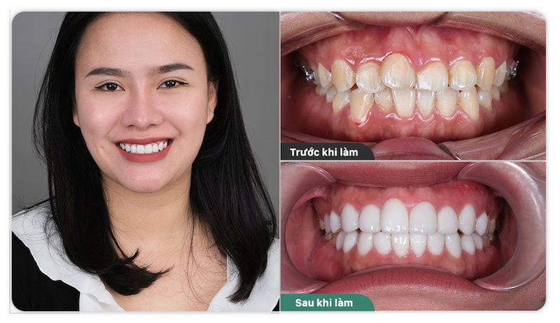 Hình ảnh trước và sau khi trồng răng Implant tại Vidental của Chị Nguyễn Thị Hương.